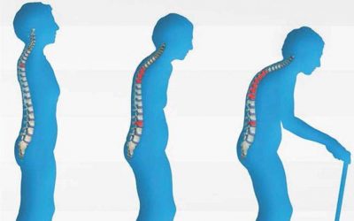 Osteoporosis Prevention Through Chiropractic Care