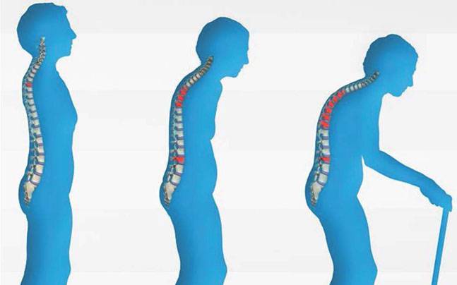Osteoporosis Prevention Through Chiropractic Care